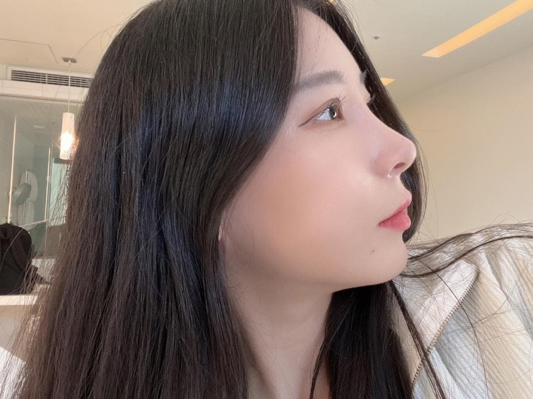 เสริมสันจมูกด้วยกระดูกอ่อนตัวเอง