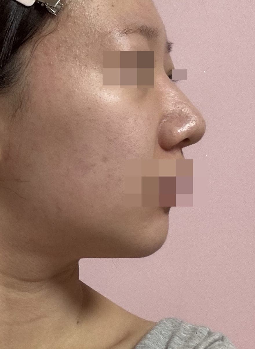 Kasus ujung bulbous dan ujung hidung sekaligus + osteotomi
