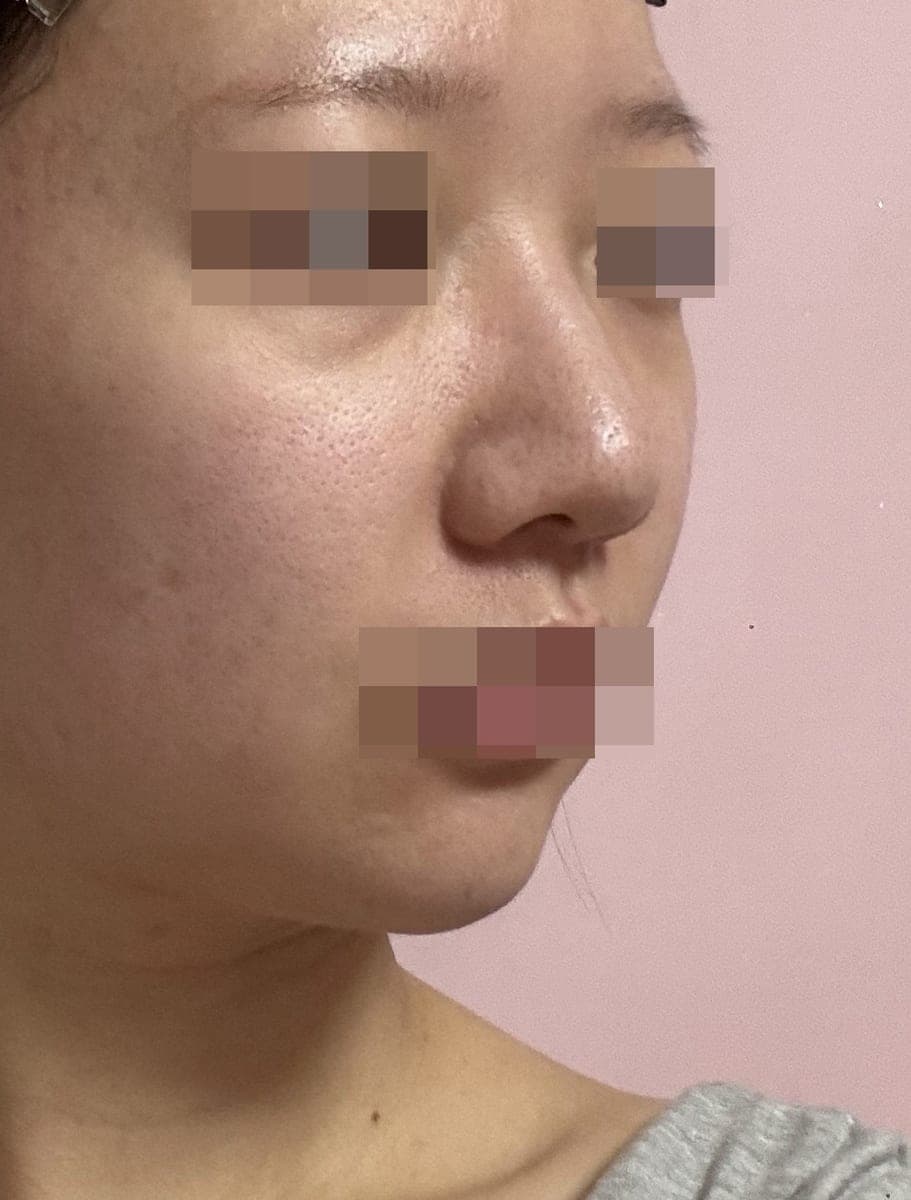 Kasus ujung bulbous dan ujung hidung sekaligus + osteotomi