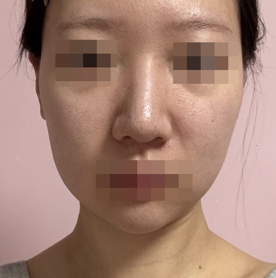 Kasus ujung bulbous dan ujung hidung sekaligus + osteotomi