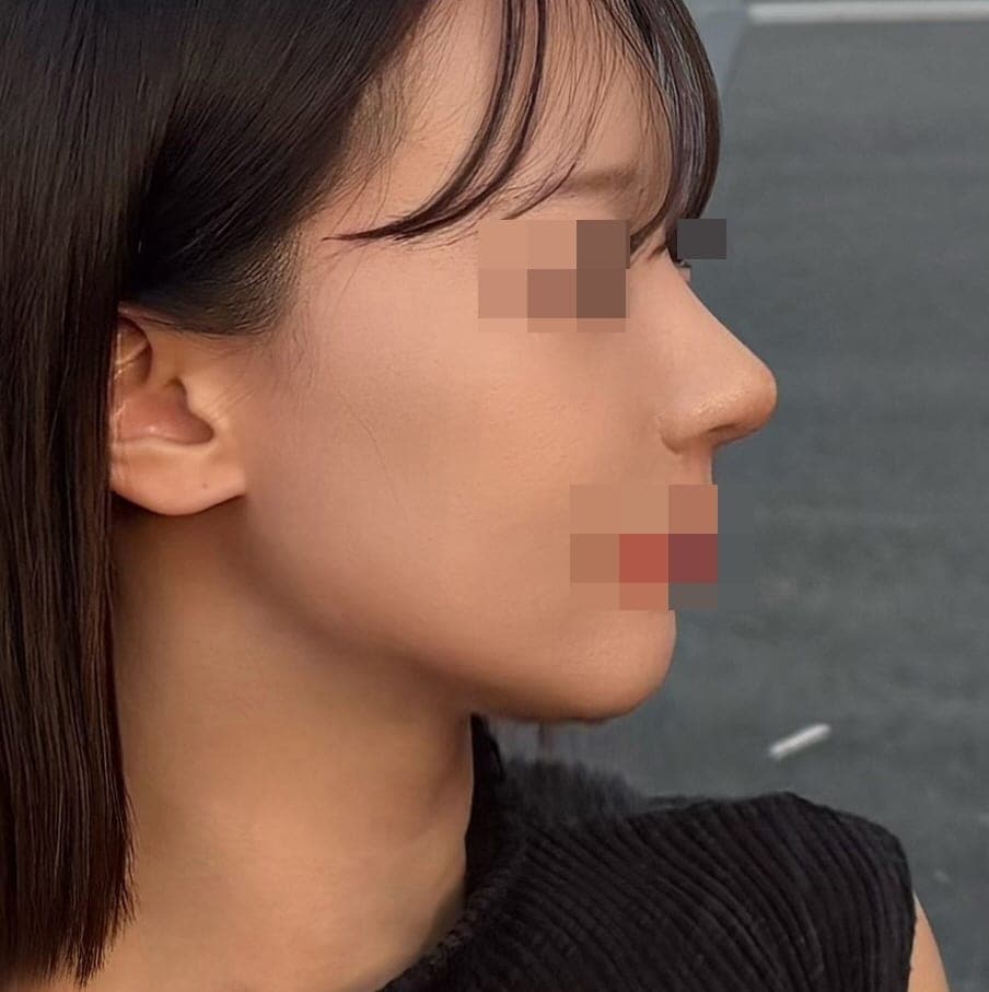 Kasus ujung bulbous dan ujung hidung sekaligus + osteotomi