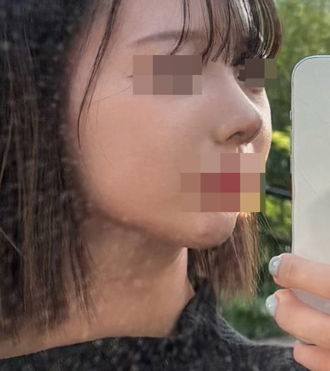 Kasus ujung bulbous dan ujung hidung sekaligus + osteotomi