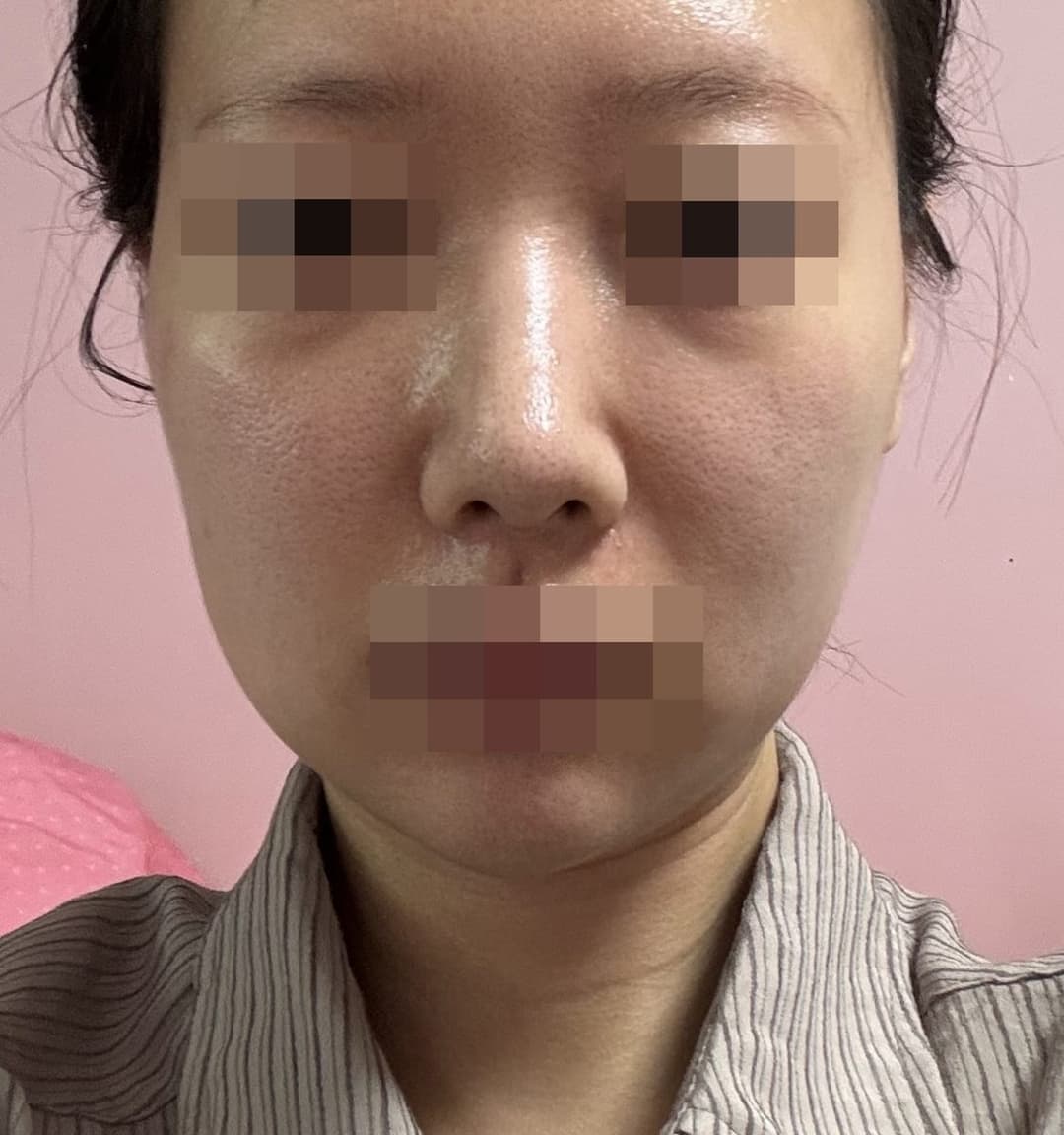 Kasus ujung bulbous dan ujung hidung sekaligus + osteotomi