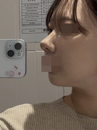 Kasus ujung bulbous dan ujung hidung sekaligus + osteotomi