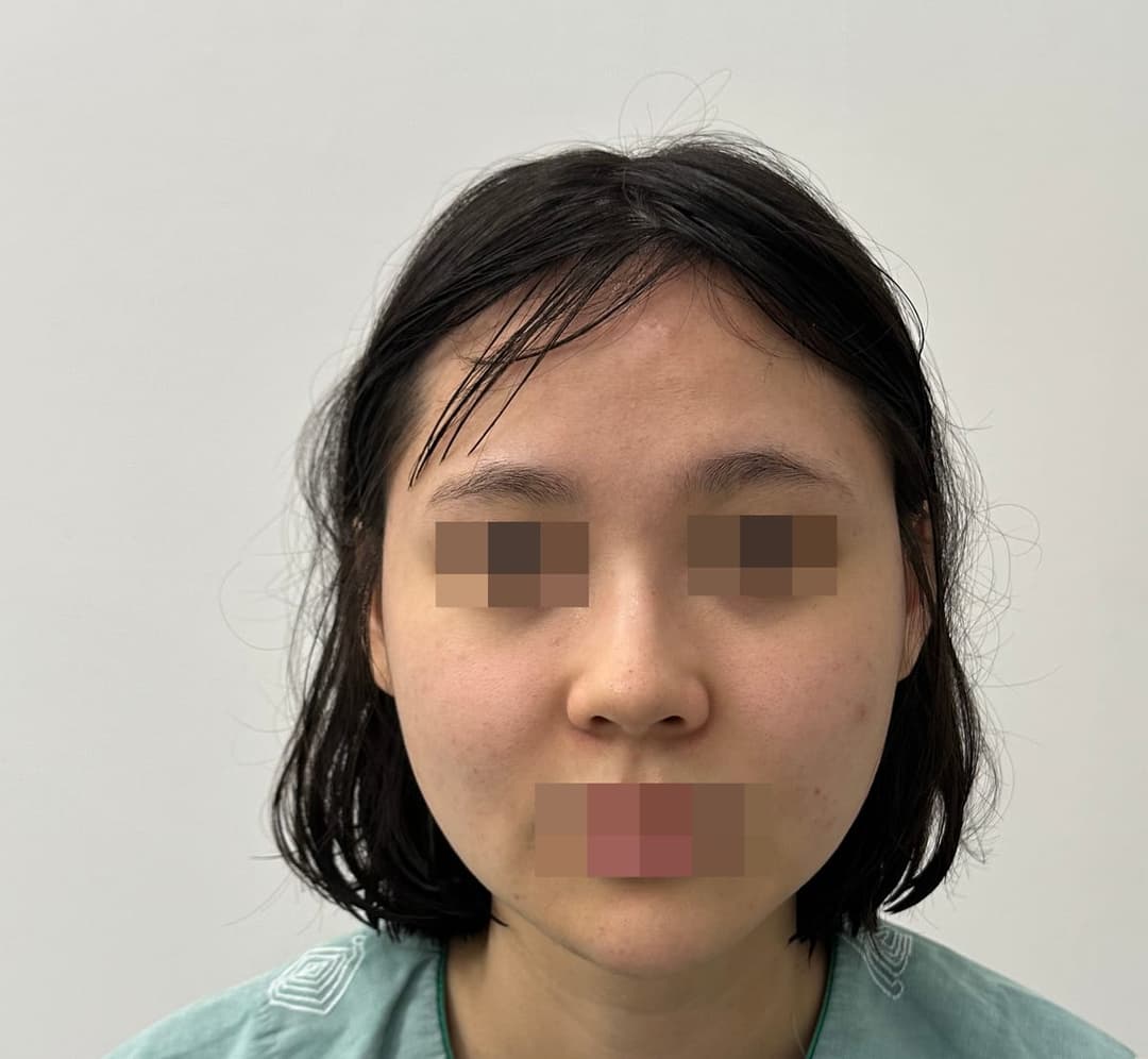 Kasus koreksi hidung berpunuk