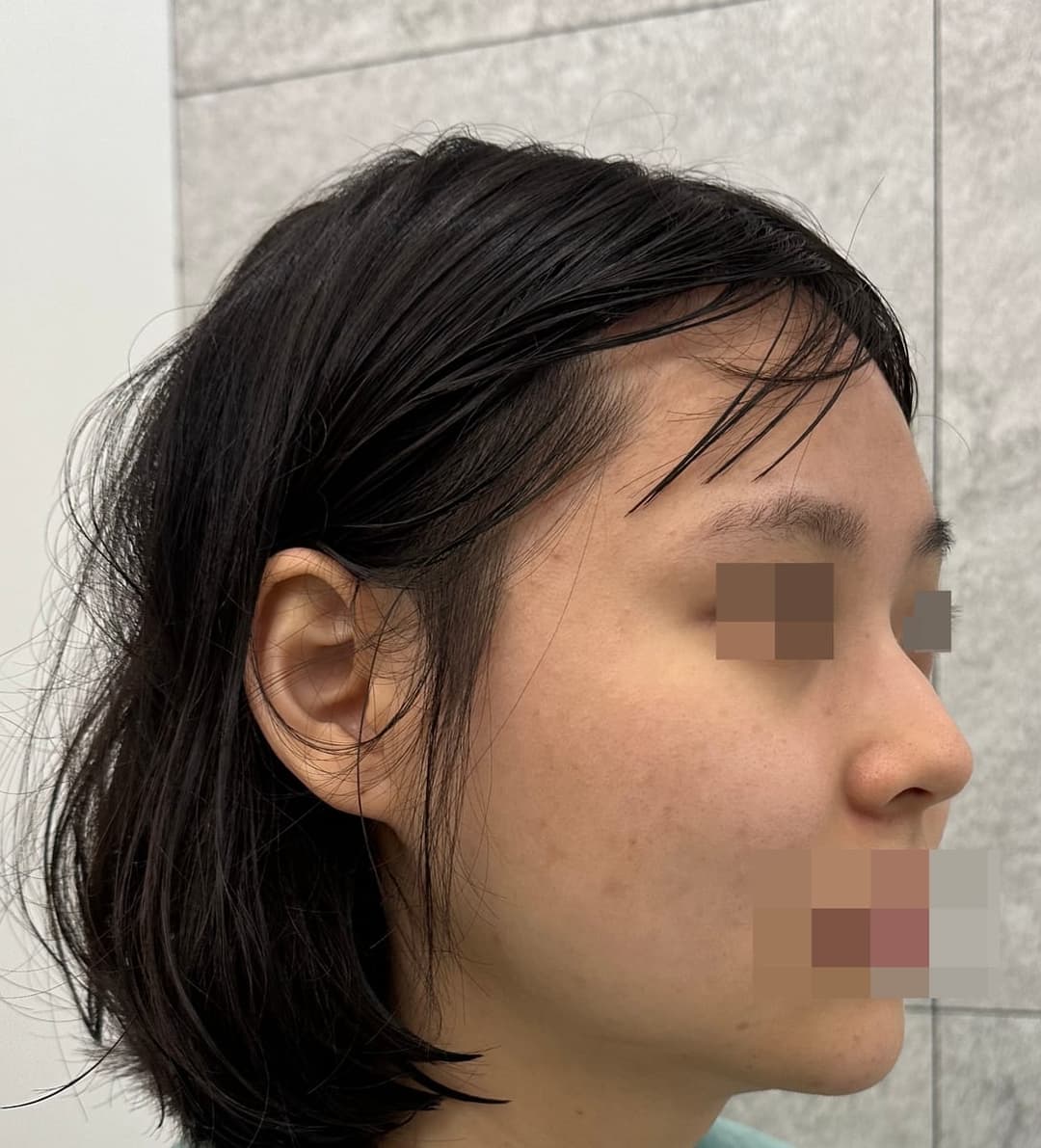 Kasus koreksi hidung berpunuk