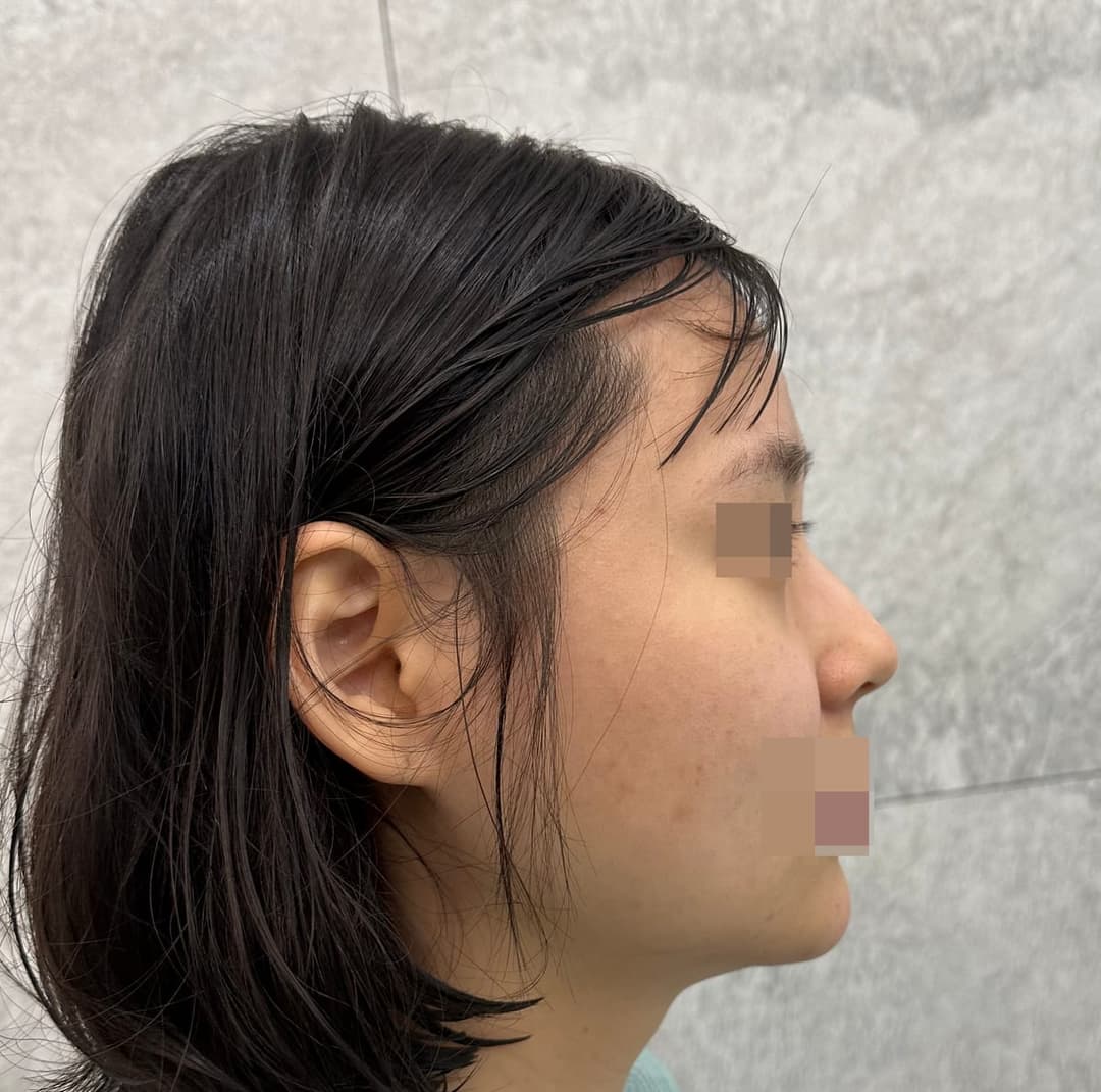 Kasus koreksi hidung berpunuk