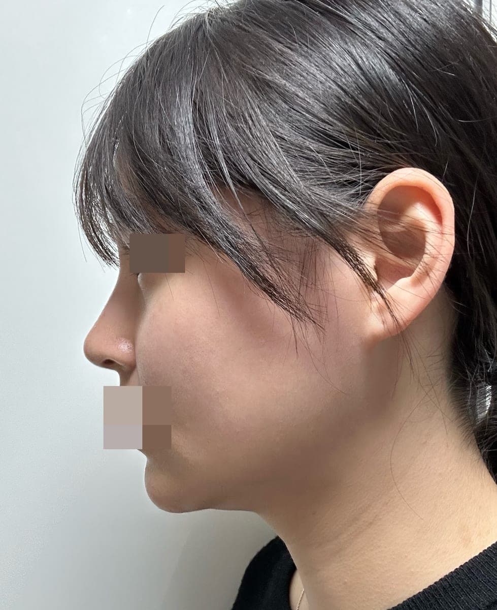 Kasus koreksi hidung berpunuk