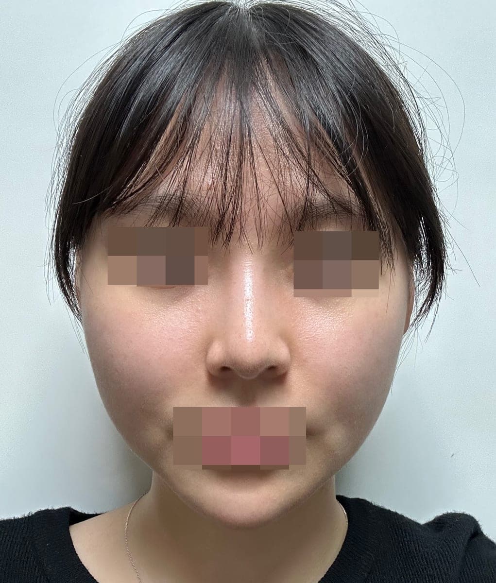 Kasus koreksi hidung berpunuk
