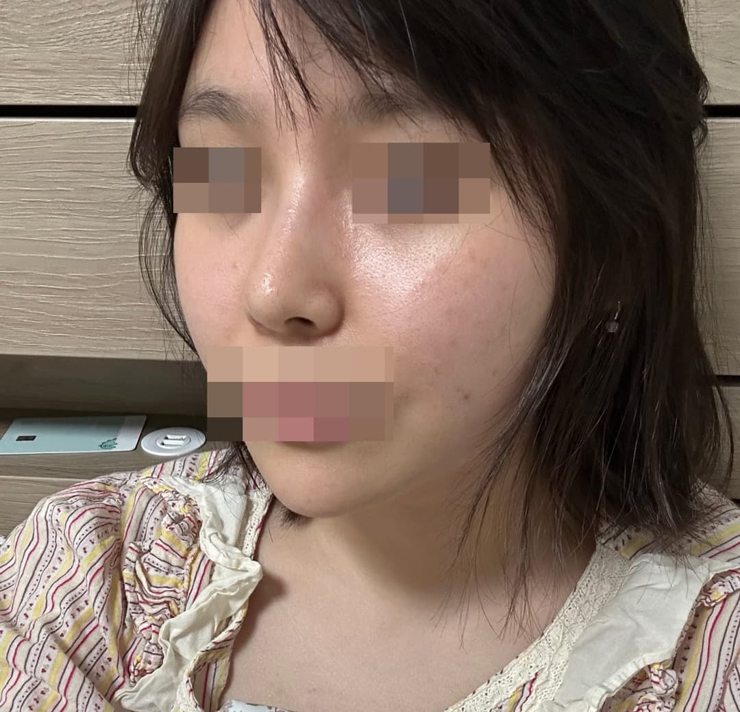 Kasus koreksi hidung berpunuk