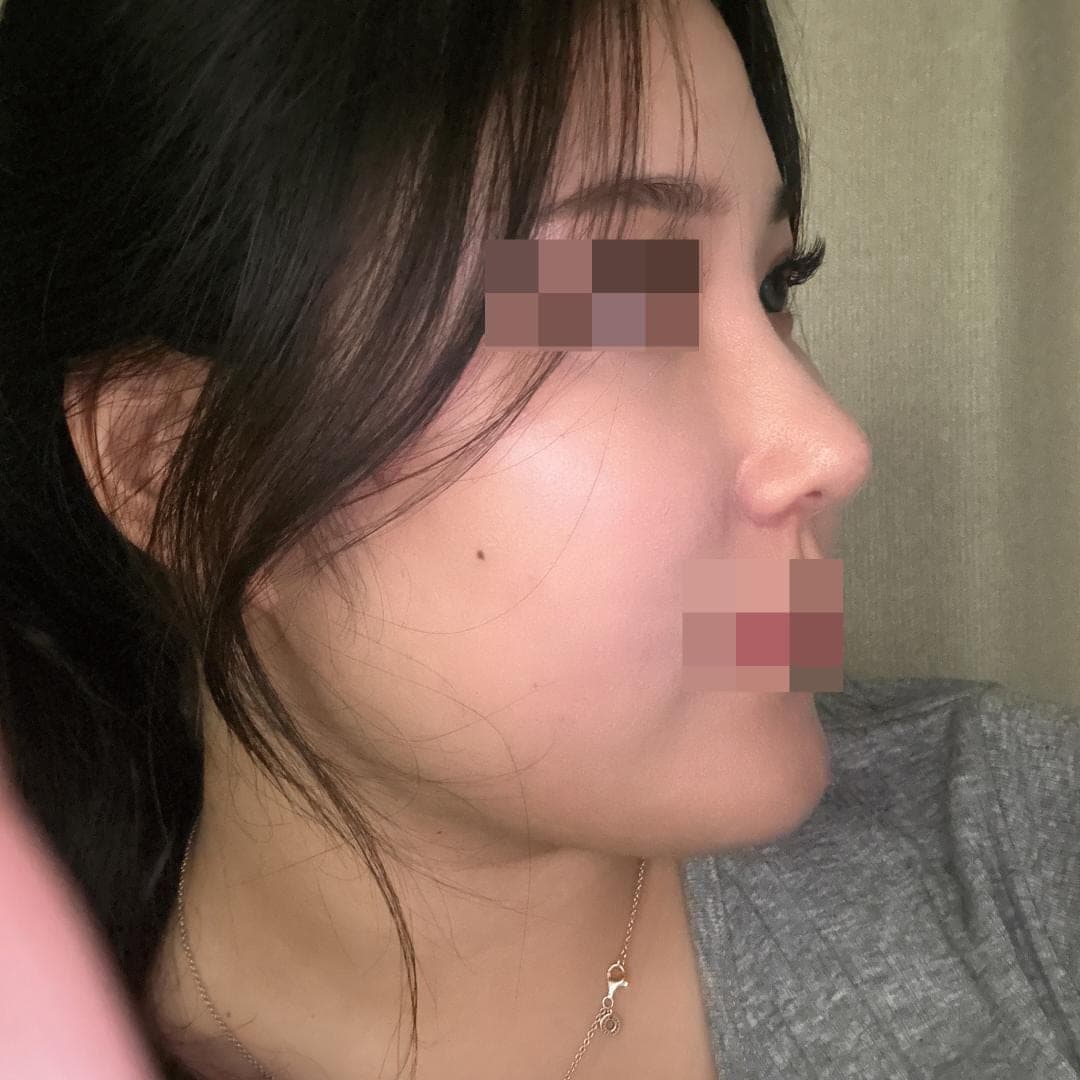 Menata ulang garis samping wajah