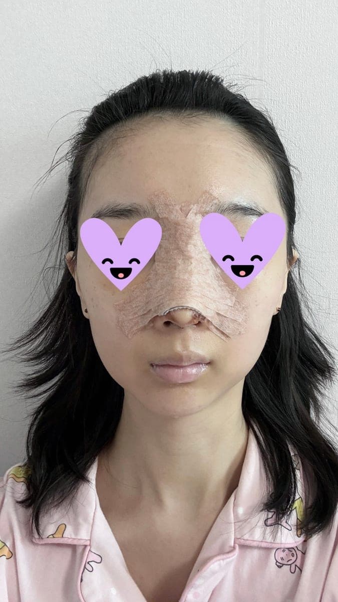 Hooked nose correction