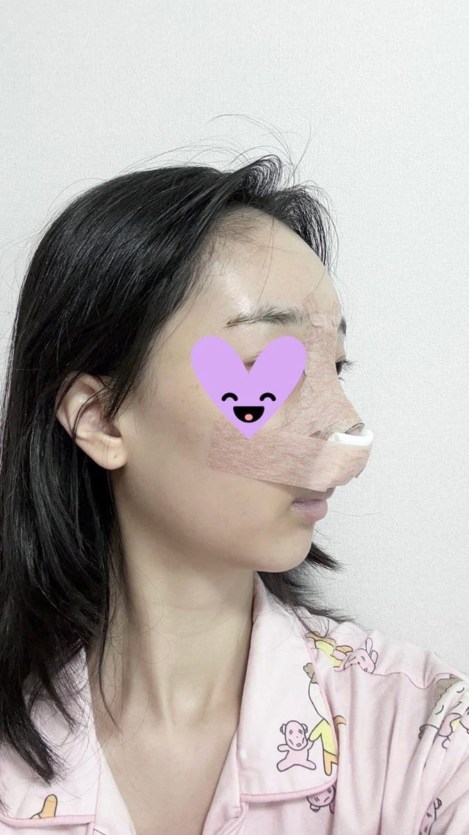 Hooked nose correction