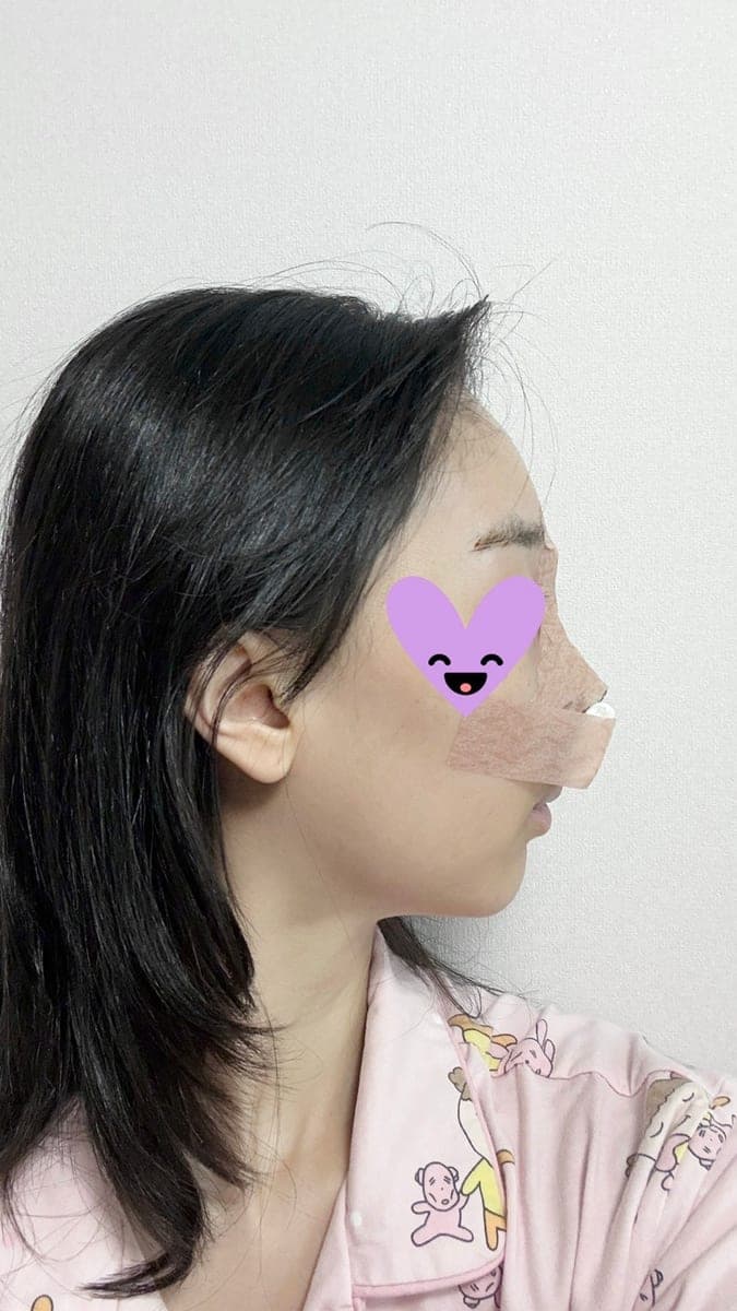 Hooked nose correction