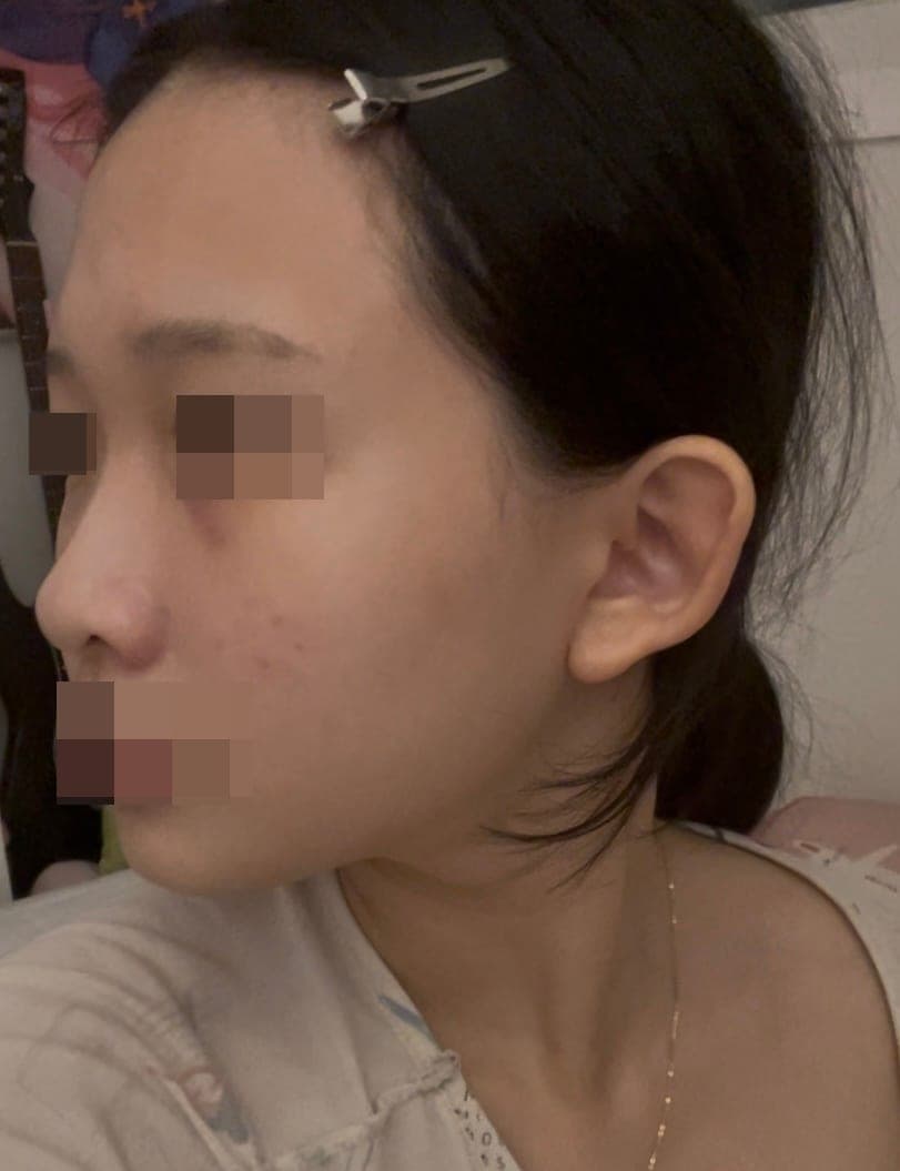 Less visible nostrils, tip with donor cartilage + osteotomy