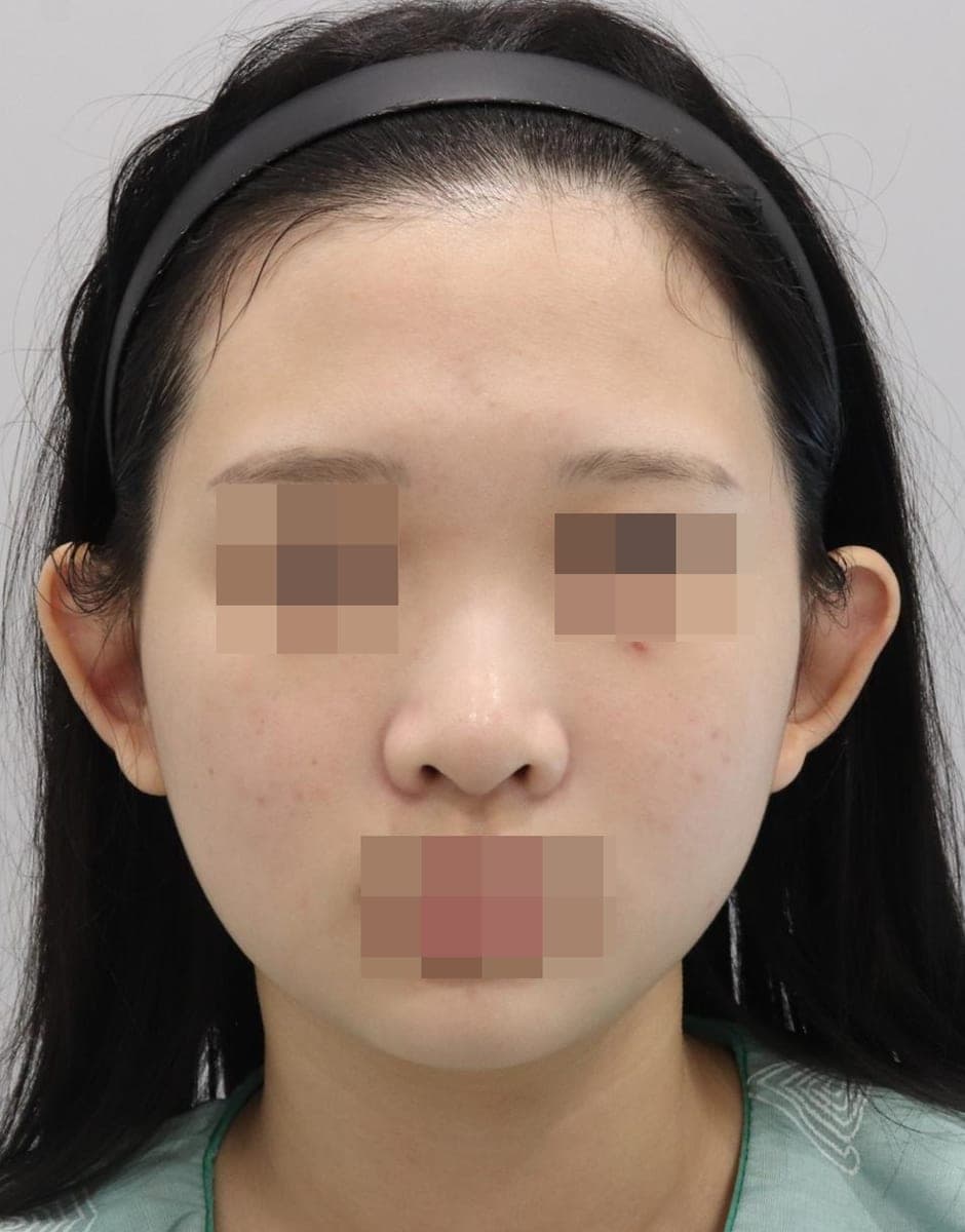 Less visible nostrils, tip with donor cartilage + osteotomy