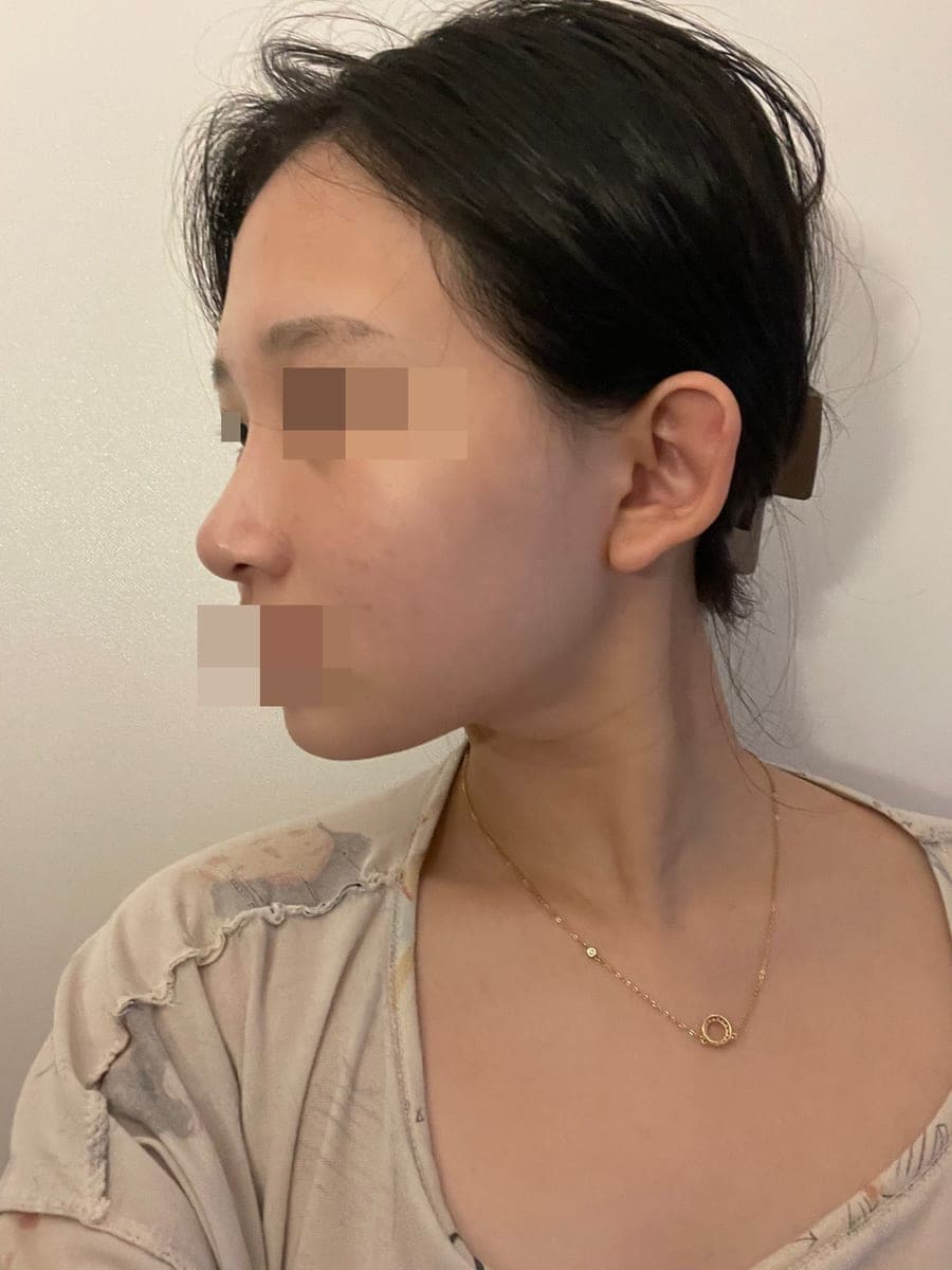 Less visible nostrils, tip with donor cartilage + osteotomy