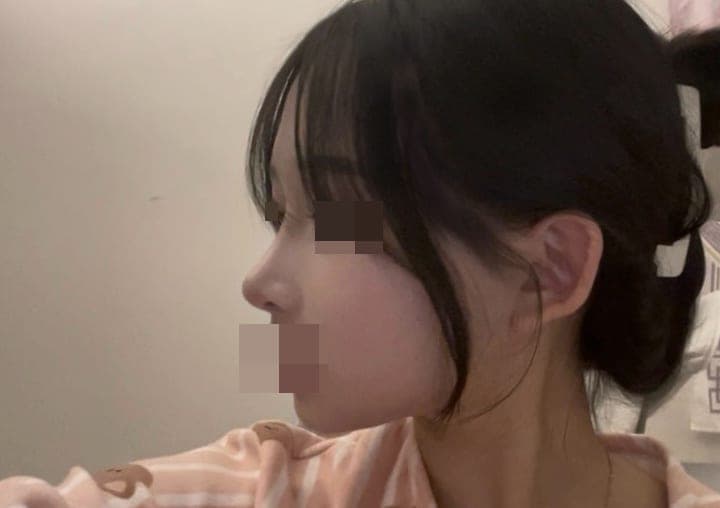 Less visible nostrils, tip with donor cartilage + osteotomy