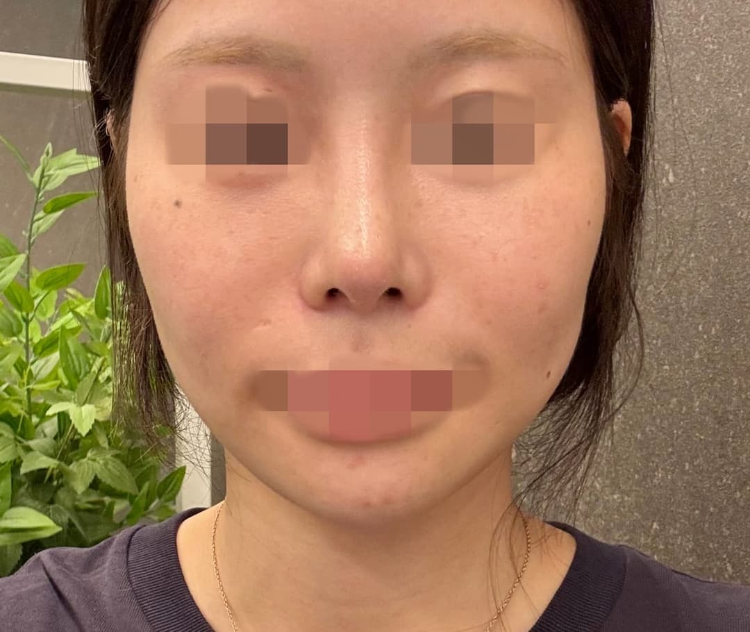 ศัลยกรรมแก้จมูก ปลายจมูกด้วยกระดูกอ่อนตัวเอง
