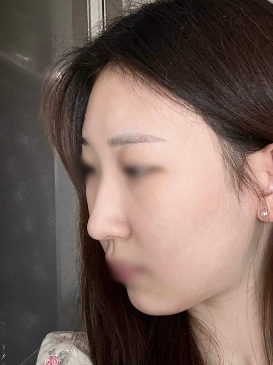 Kasus ujung bulbous dan ujung hidung sekaligus + osteotomi