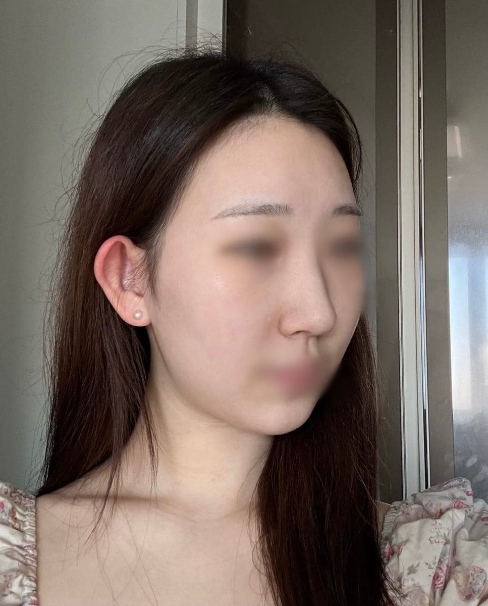 Kasus ujung bulbous dan ujung hidung sekaligus + osteotomi