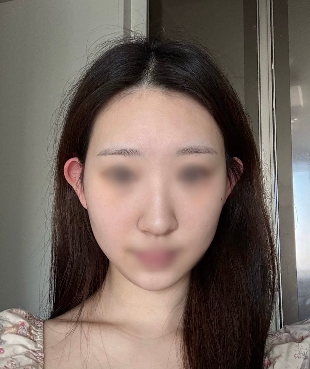 Kasus ujung bulbous dan ujung hidung sekaligus + osteotomi