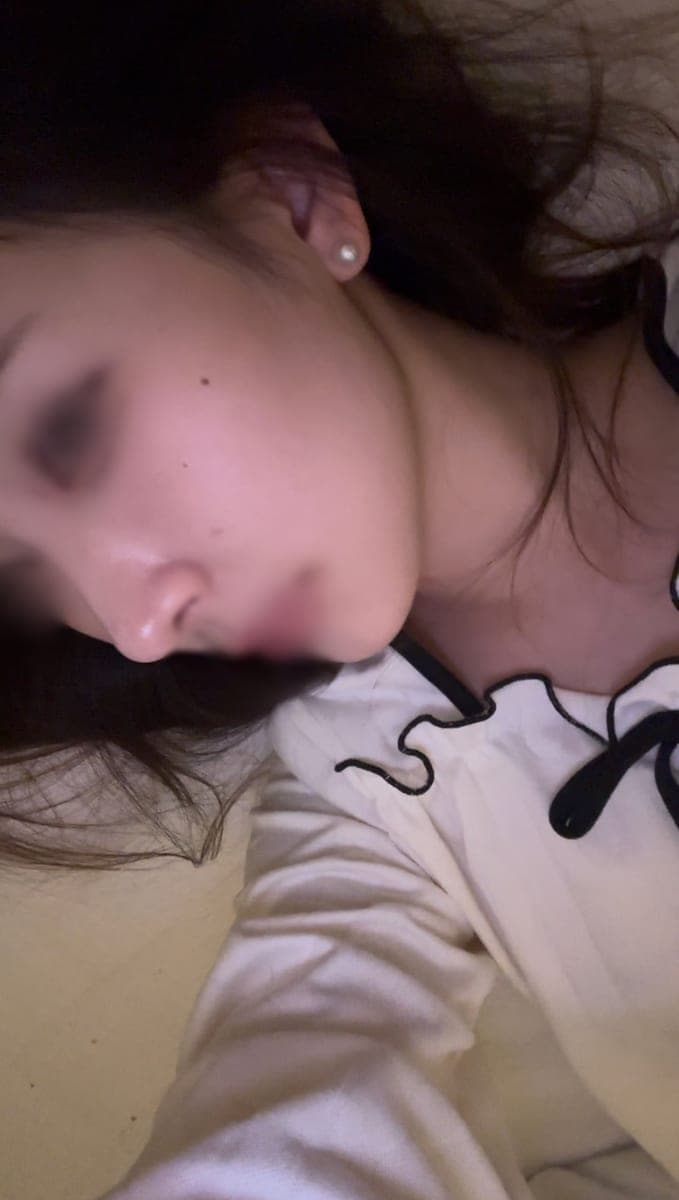 Kasus ujung bulbous dan ujung hidung sekaligus + osteotomi