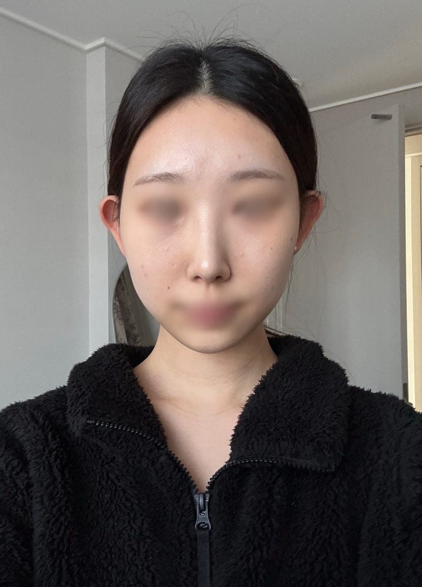 Kasus ujung bulbous dan ujung hidung sekaligus + osteotomi