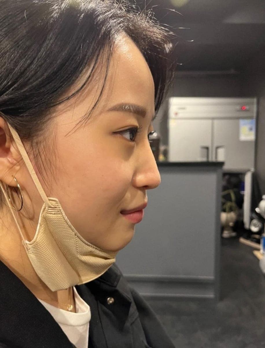 Tip plasty with own cartilage