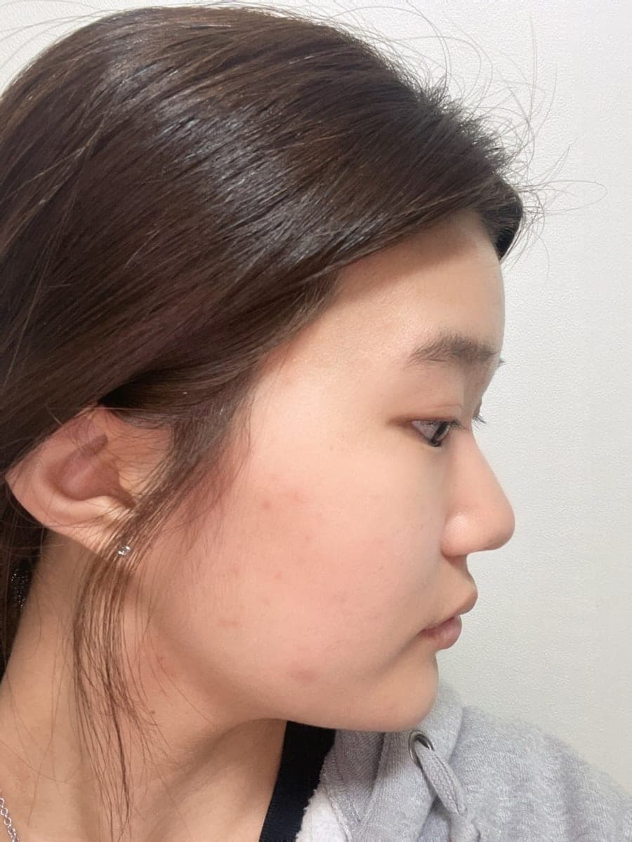 Menata ulang garis samping wajah
