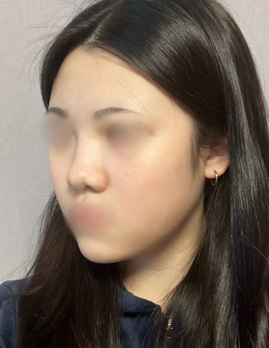 Kasus operasi ujung hidung