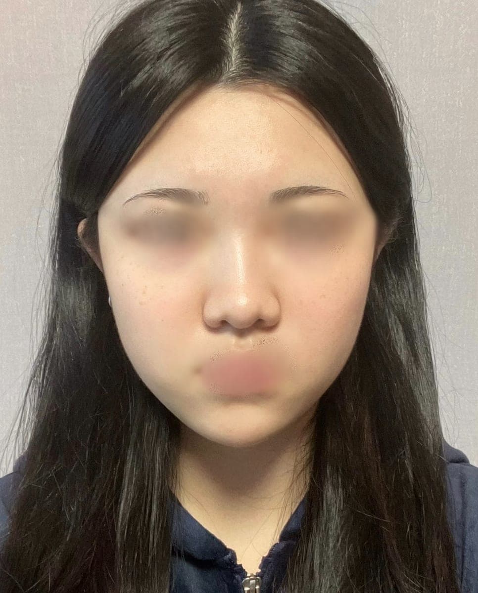 Kasus operasi ujung hidung