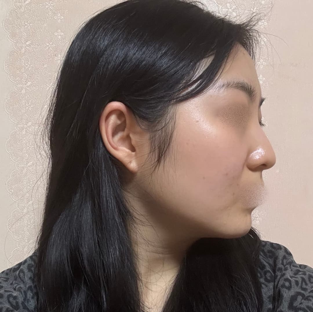 Kasus koreksi hidung bulbous + osteotomi