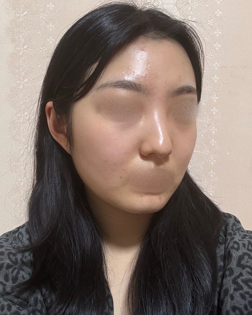 Kasus koreksi hidung bulbous + osteotomi