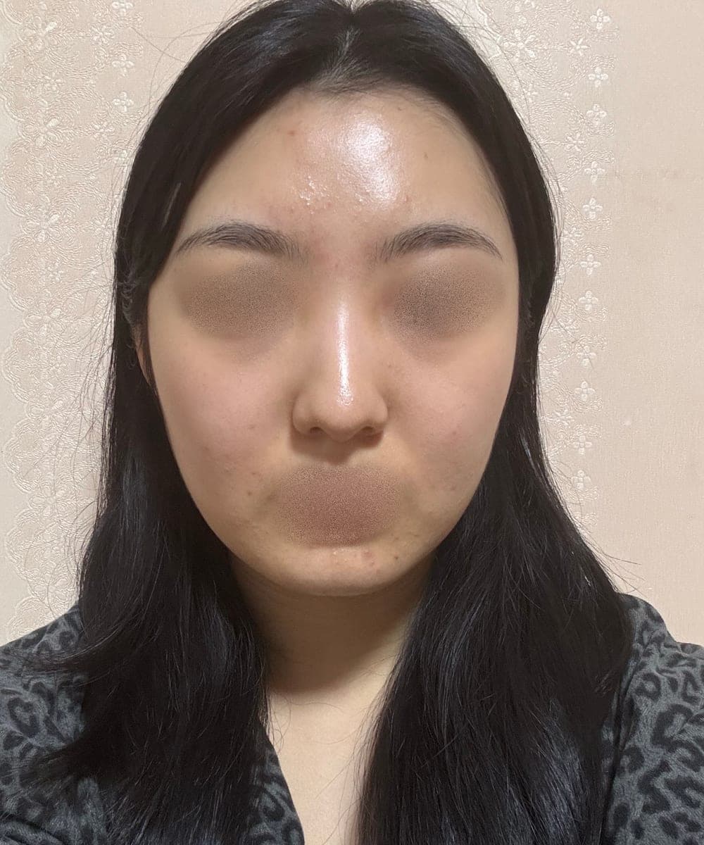 Kasus koreksi hidung bulbous + osteotomi