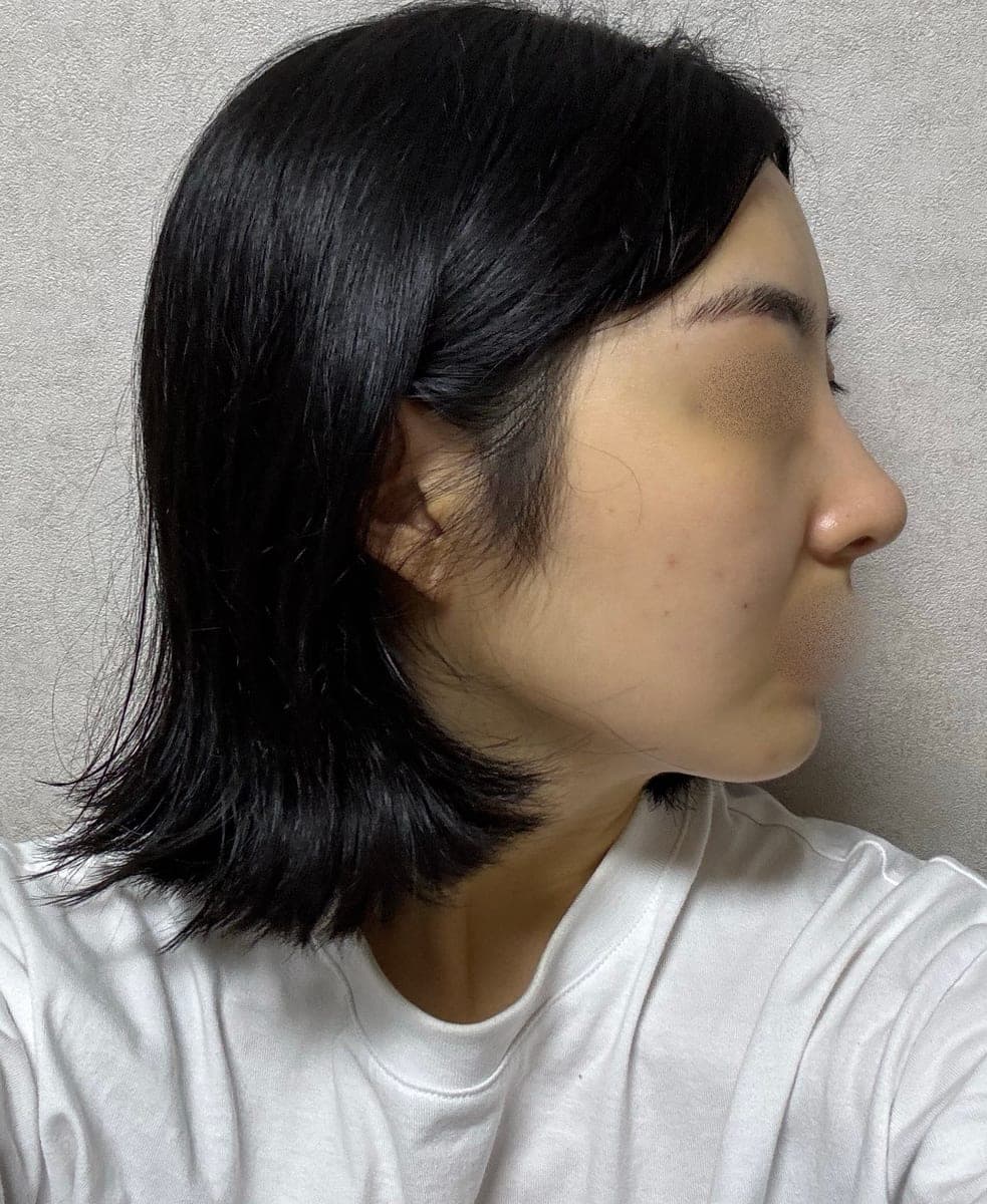 Kasus koreksi hidung bulbous + osteotomi