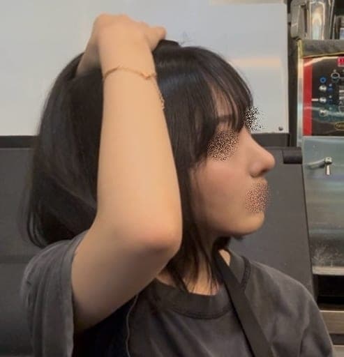 Kasus koreksi hidung bulbous + osteotomi