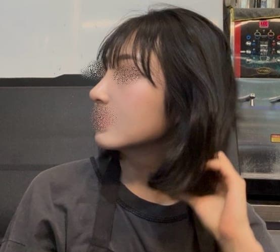 Kasus koreksi hidung bulbous + osteotomi