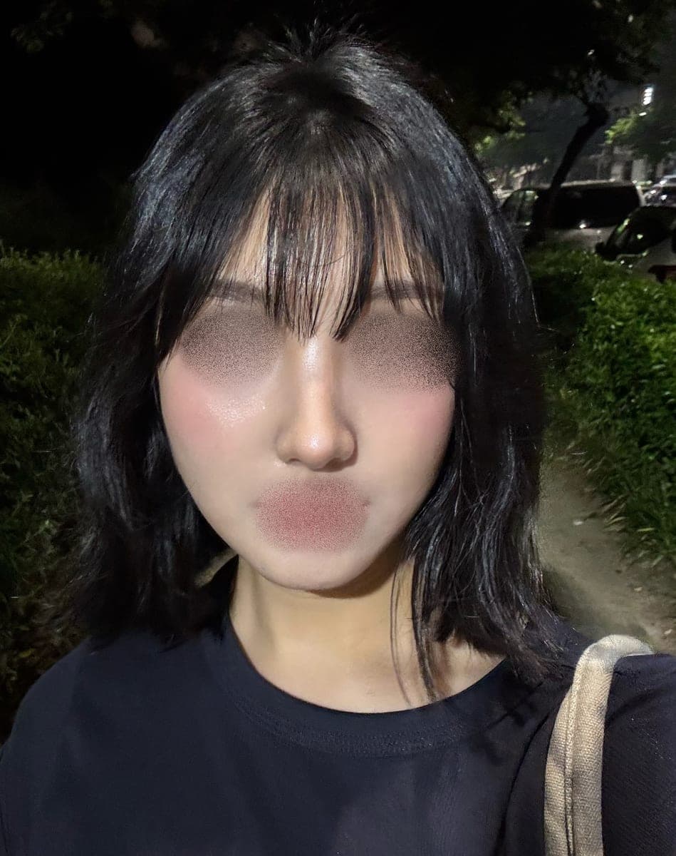 Kasus koreksi hidung bulbous + osteotomi