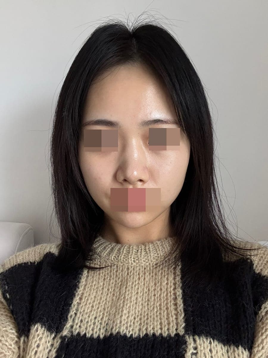 จัดเส้นจมูกใหม่ด้วยการแก้ + เหลากระดูก