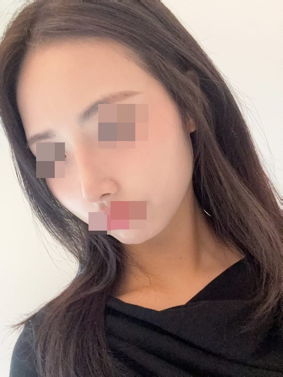 จัดเส้นจมูกใหม่ด้วยการแก้ + เหลากระดูก