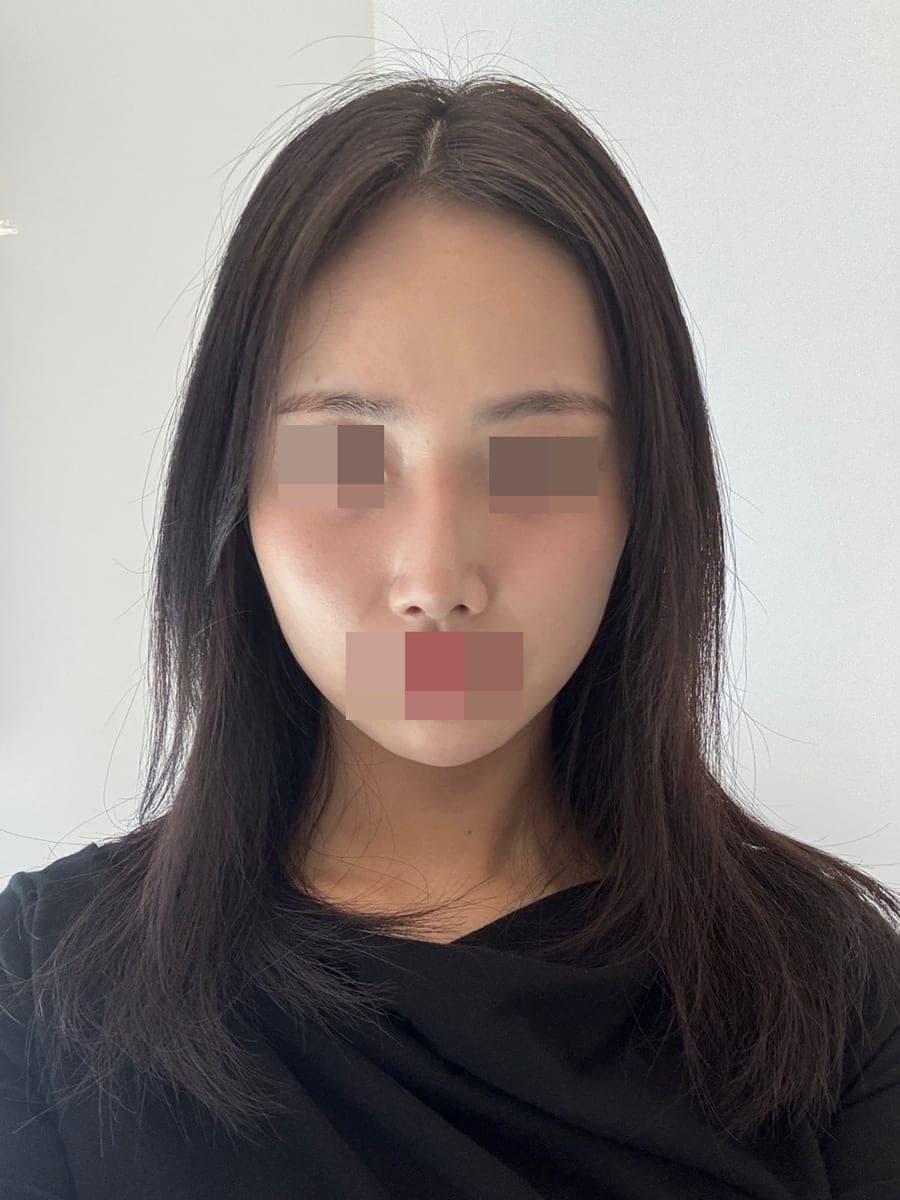 จัดเส้นจมูกใหม่ด้วยการแก้ + เหลากระดูก