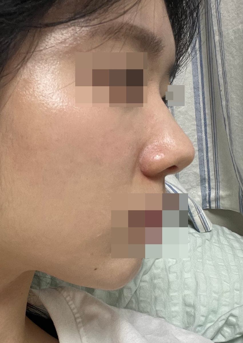 Koreksi ujung bulbous, ujung dengan tulang rawan donor + osteotomi