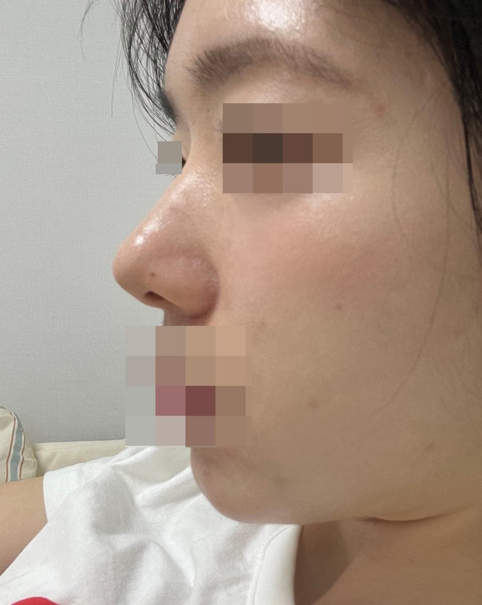 Koreksi ujung bulbous, ujung dengan tulang rawan donor + osteotomi