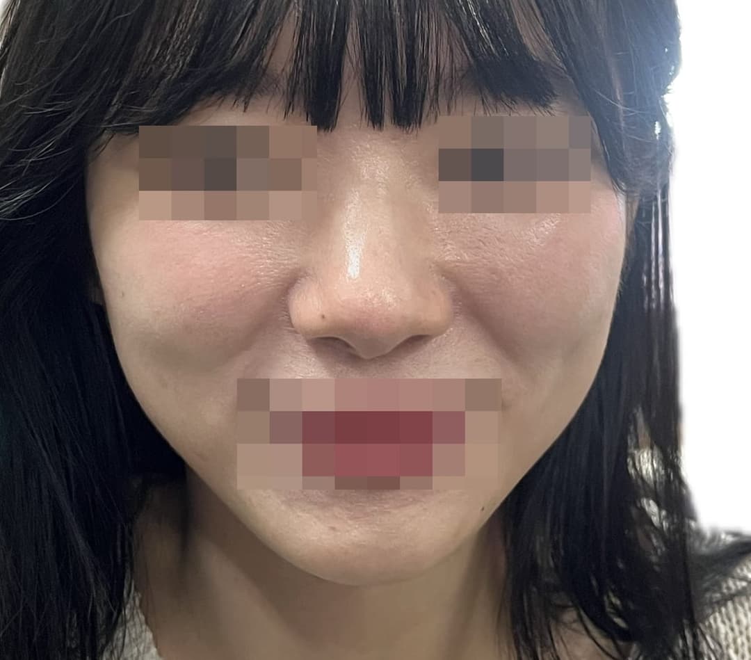 Koreksi ujung bulbous, ujung dengan tulang rawan donor + osteotomi