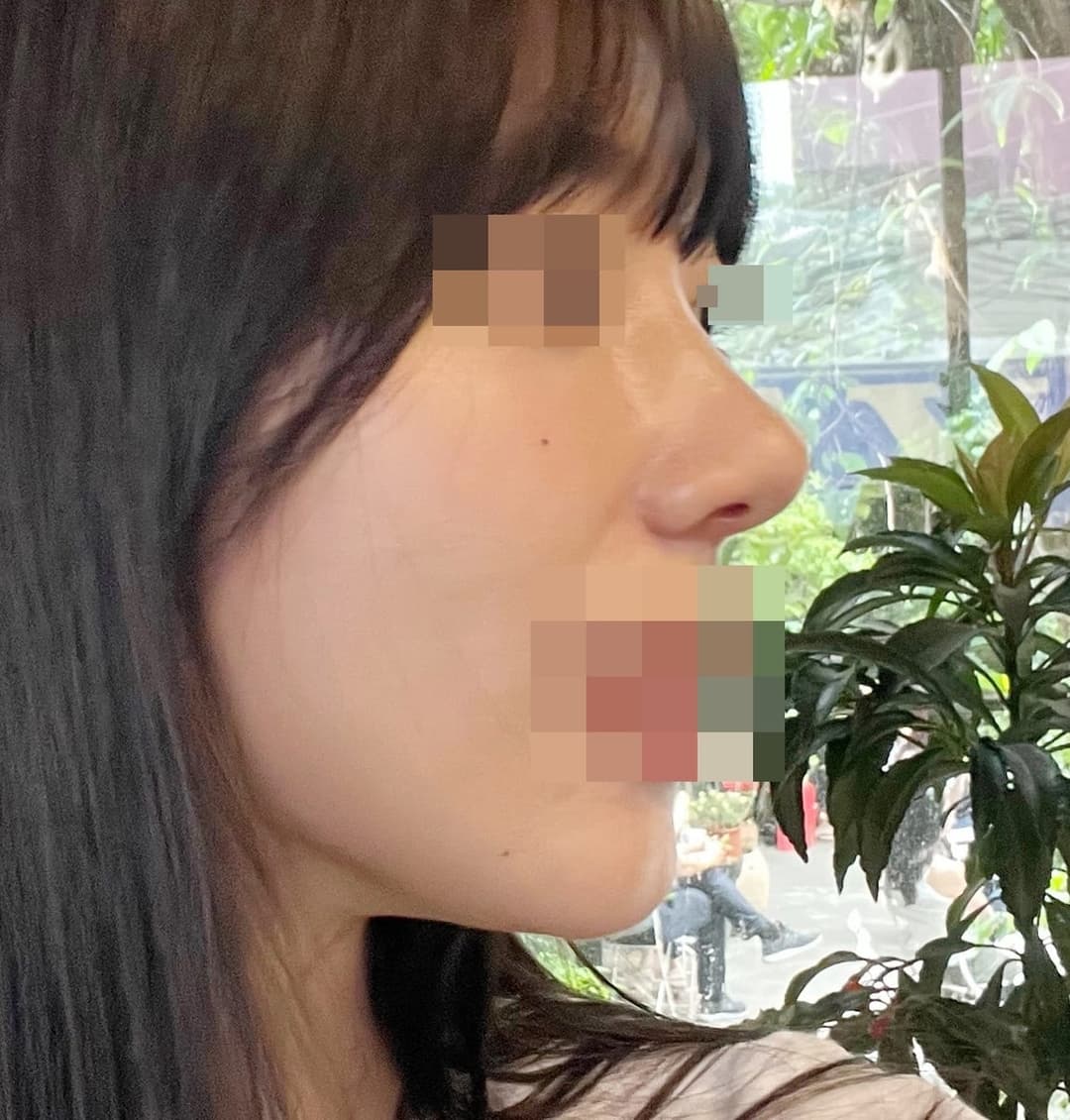 Koreksi ujung bulbous, ujung dengan tulang rawan donor + osteotomi