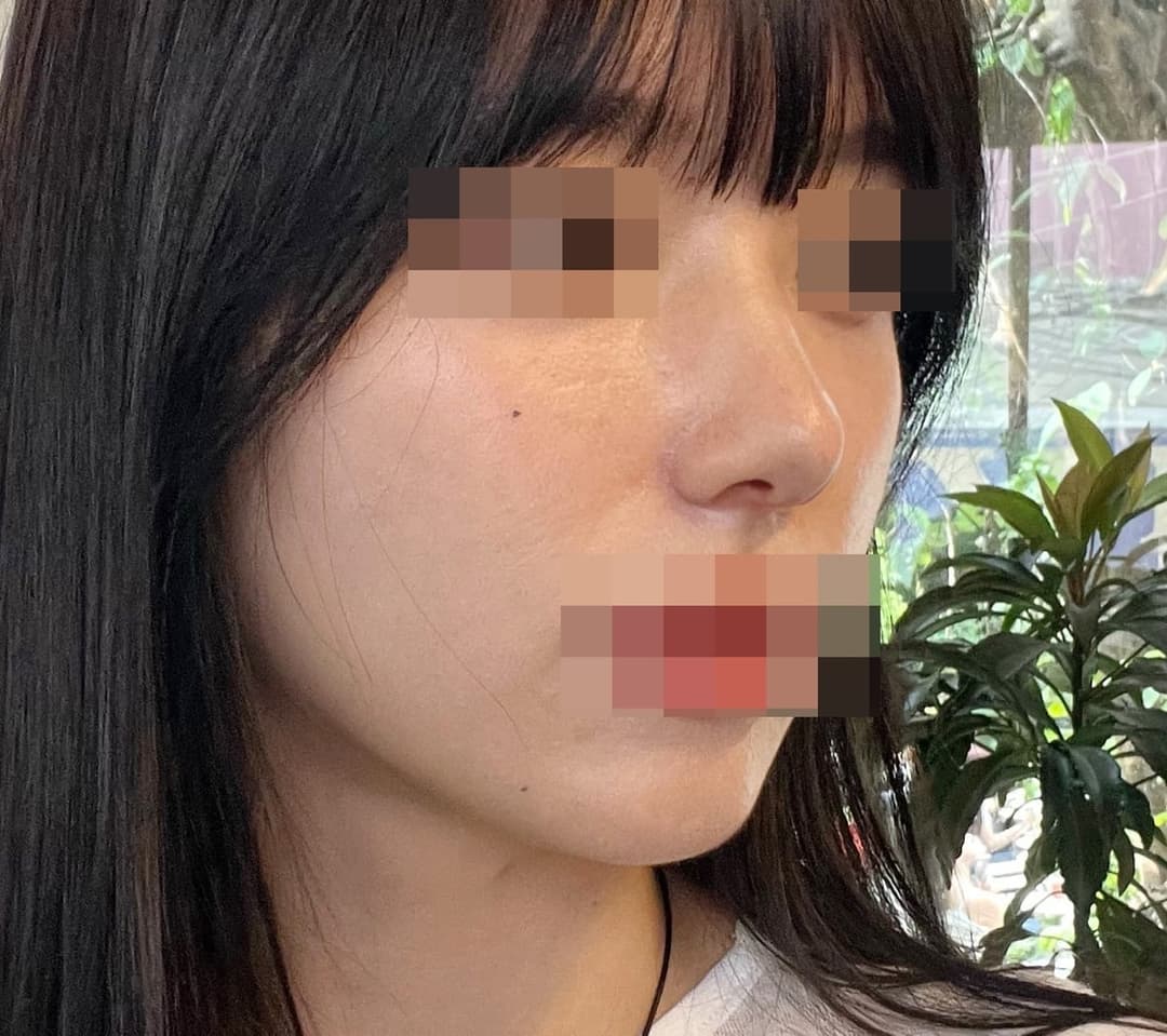 Koreksi ujung bulbous, ujung dengan tulang rawan donor + osteotomi