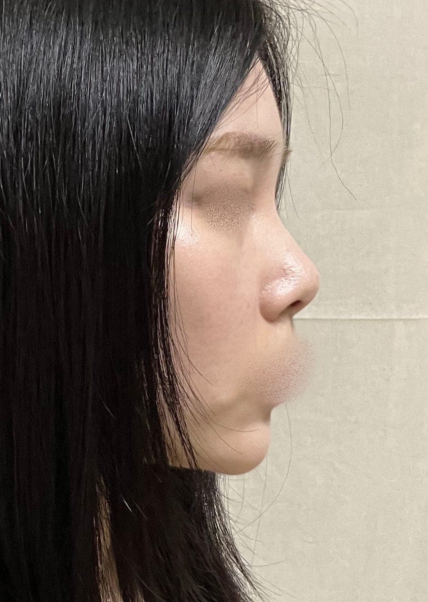 Ujung tebal dibuat tipis dengan tulang rawan donor + osteotomi