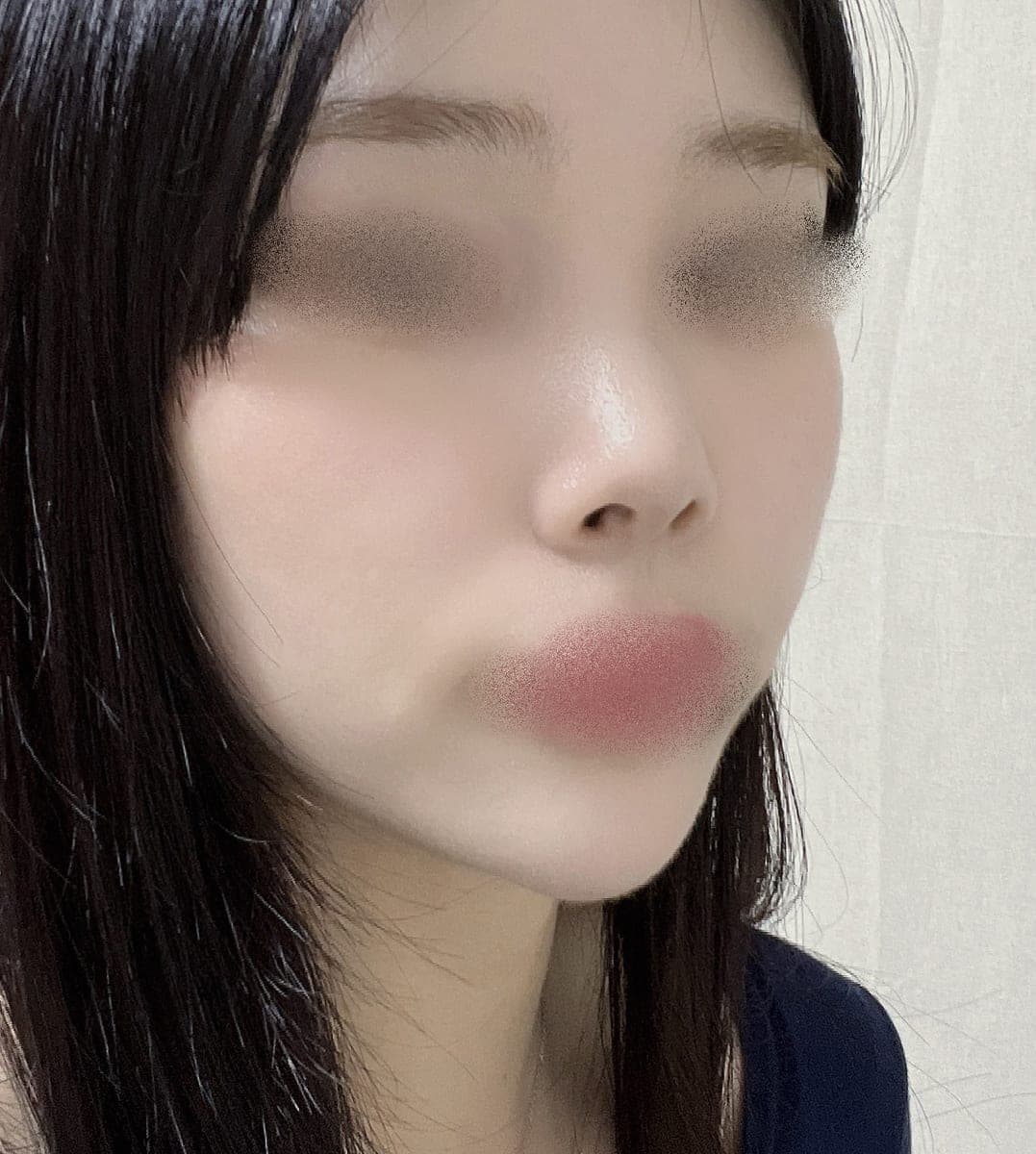 Ujung tebal dibuat tipis dengan tulang rawan donor + osteotomi