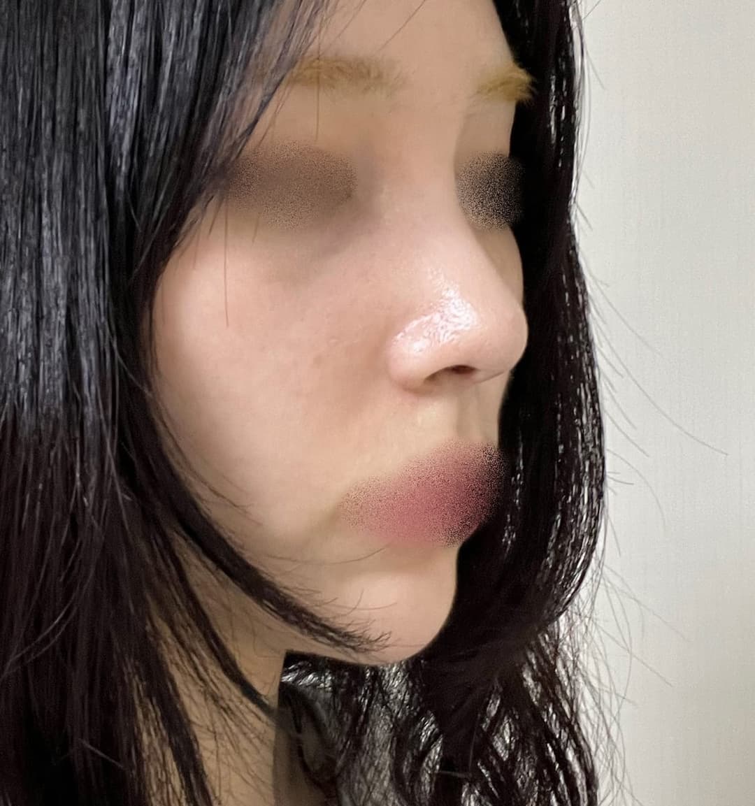 Ujung tebal dibuat tipis dengan tulang rawan donor + osteotomi